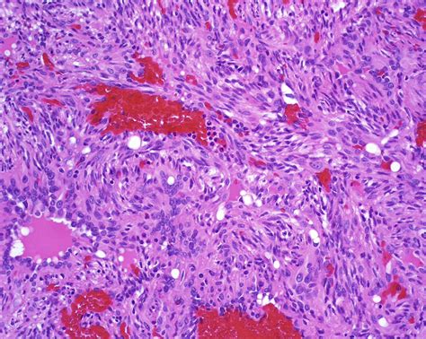 Spindle Cell Hemangioma Treatment at Alice Pace blog