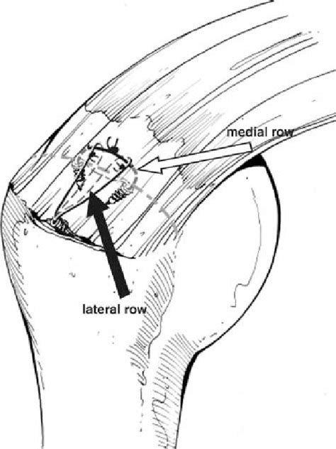 Image result for Single Row Rotator Cuff Repair