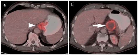 PET-CT in Clinical Adult Oncology: III. Gastrointestinal Malignancies