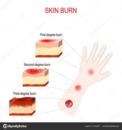 Diagrama De Quemaduras De Tercer Grado