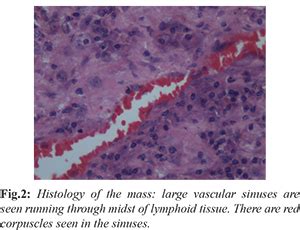 Large Groin Mass due to Vascular Transformation of Lymph Node Sinuses