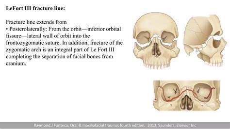 Midface fracture.pptx