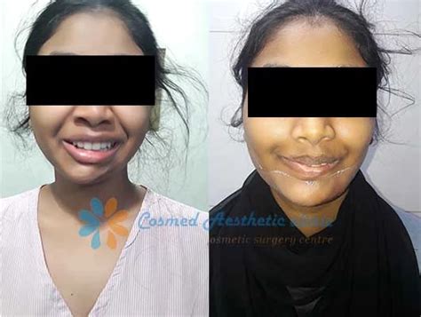 Cosmed Aesthetic Clinic Image Gallery | Before and After Pics