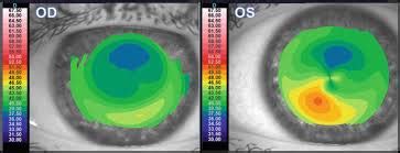 ST-Cornea Observation Course (24 Days) - Susrut