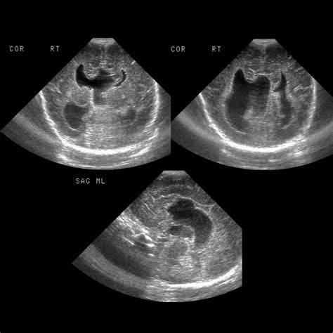 Agenesis of Corpus Callosum | Pediatric Radiology Reference Article | Pediatric Imaging ...