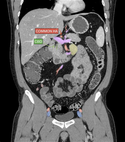 Abdomen And Pelvis Ct