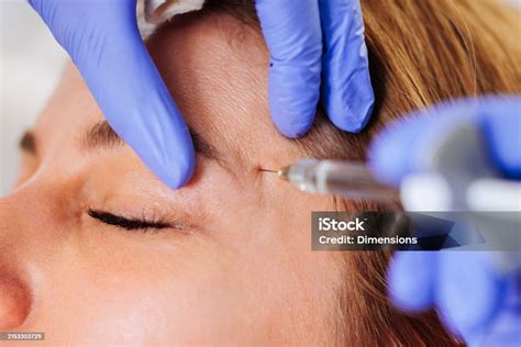 Image result for Botox Injection Pattern Forehead