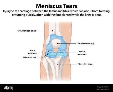 Illustration of knee meniscus tear anatomy Stock Vector Image & Art - Alamy