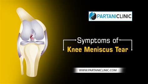 8 Main Symptoms of Knee Meniscus Tear - Dr. Arun Partani