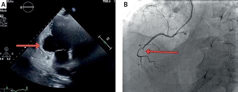 Critical insights into the diagnosis and management of post-myocardial ...