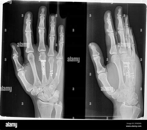 Image result for Open Fracture Surgery