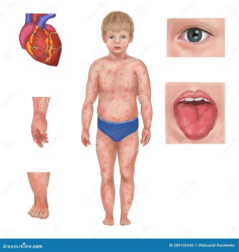 Kawasaki Disease Symptoms. Common Signs of Kawasaki Syndrome Stock Illustration - Illustration ...