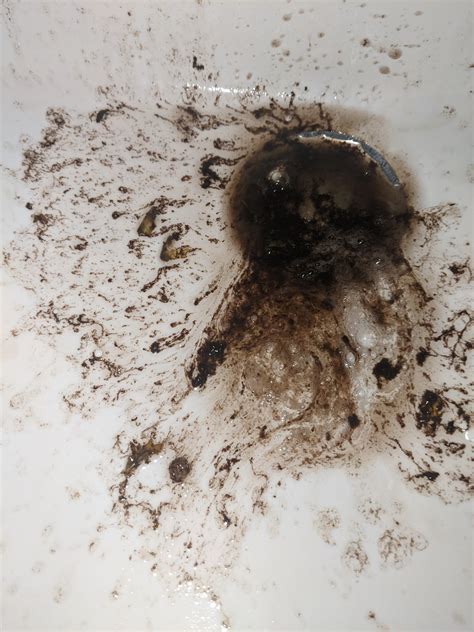 Coffee Ground Vomit Woman With Coffee Ground Emesis Annals Of