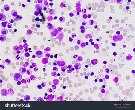 Pernicious Anemia Slide