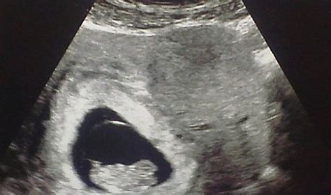 Image result for Alien Baby Ultrasound Scene