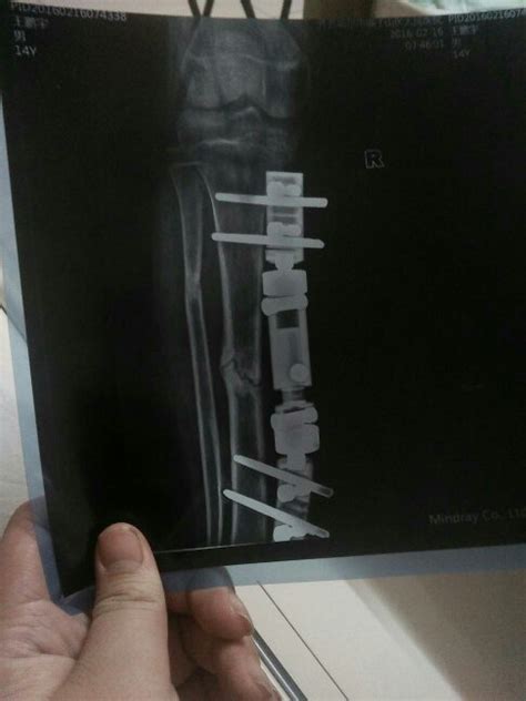我16岁，男，小腿胫腓骨粉碎性骨折，因外伤用的外固定架，现在7个月骨不连，需要植骨，请问用自身骨好_百度知道