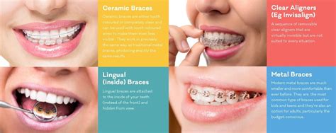 Orthodontic Treatment | Smile Dental Solutions