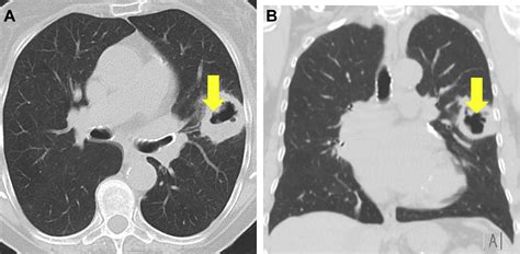 Cavitary Lung Diseases - CHEST