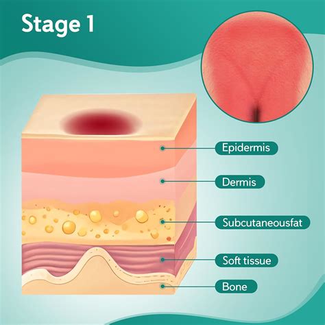 Four Stages of Pressure Ulcers: Symptoms, Care, and Prevention ...