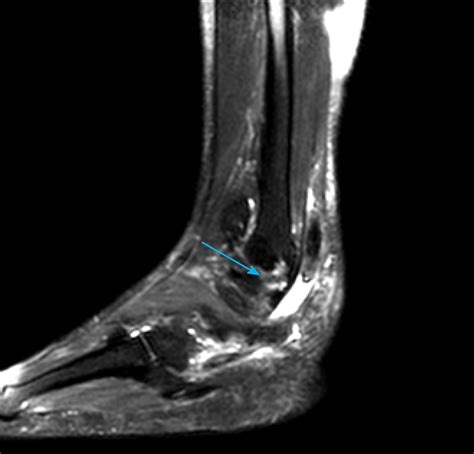 Minimally invasive tenodesis for peroneus longus tendon rupture: A case report and review of ...