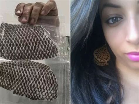 Brazilian Woman Born Without A Vagina Has A New One Made Using Tilapia ...