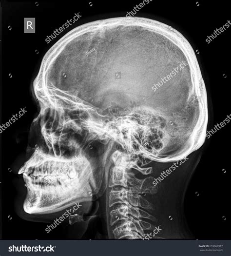 What Does A Normal Skull X Ray Look Like at Gary Cathey blog
