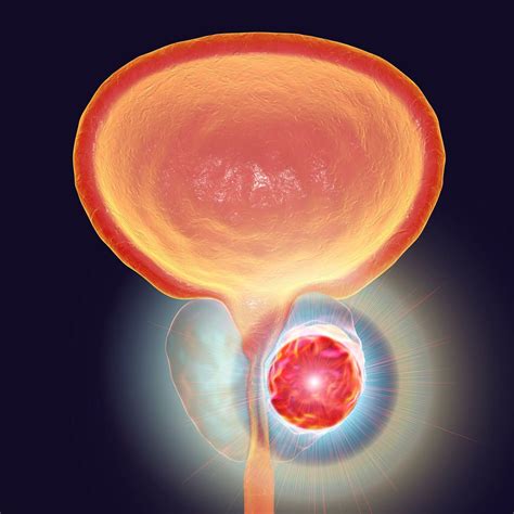 Relugolix im Vergleich zu Degarelix bei Patienten mit Prostatakrebs ...