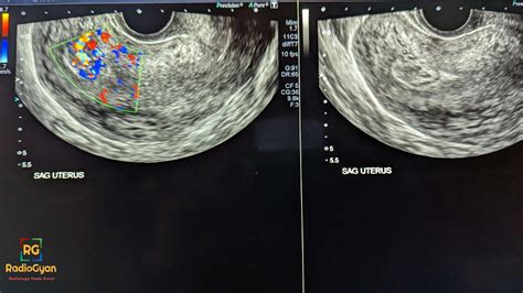 Retained Products Of Conception | Radiology Case
