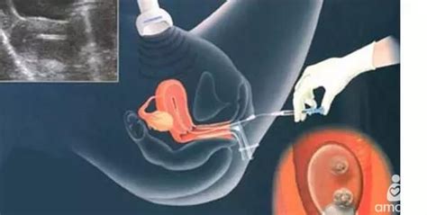 你知道无痛取卵和传统取卵术的差距在哪吗？-美中宜和试管婴儿生殖中心
