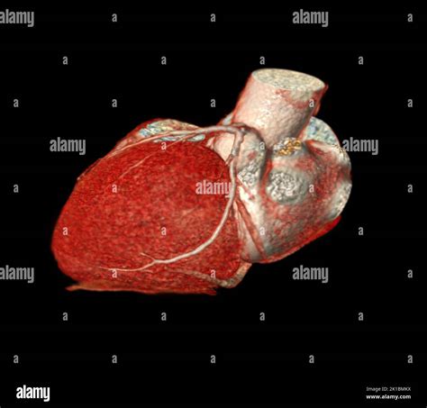 CT Cardiac 3D or CTA coronary artery for prevention coronary artery diseases Stock Photo - Alamy