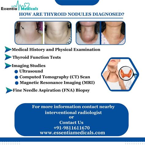 Essentia Medicals | Thyroid Nodules: A Common Concern Thyroid nodules are small lumps that can ...