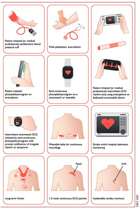 Implantable Ecg Monitor
