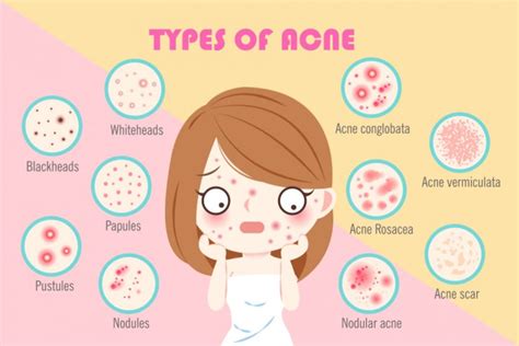Looking for Some Effective Natural Remedies to Reduce Acne Scars? Here ...
