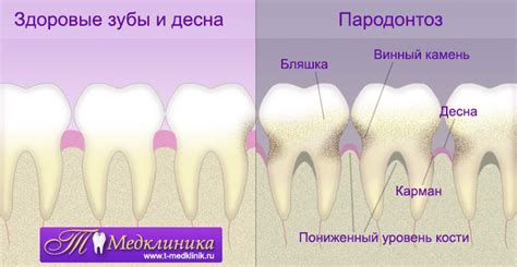 Пародонтоз - Стоматология в САО и СВАО. Стоматологическая поликлиника