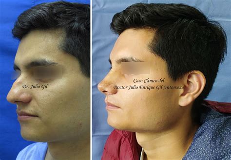 Rinoplastia precios 2022 - Cuánto cuesta? - Cirugia de Nariz - Cuánto sale