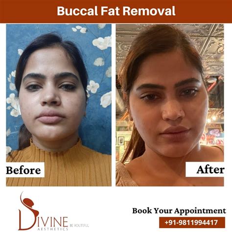 Buccal Fat Removal Surgery Cost in Delhi | Face Fat Removal in India