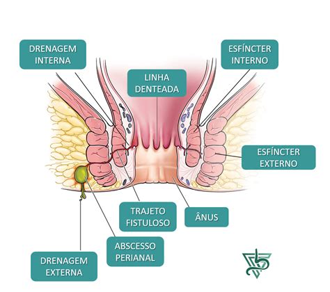 Tratamento da Fístula Anal - Fabio Israel