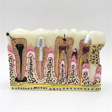Buy YHDL Tooth Pathology Model - Dental Calculus Model - Dental Oral ...