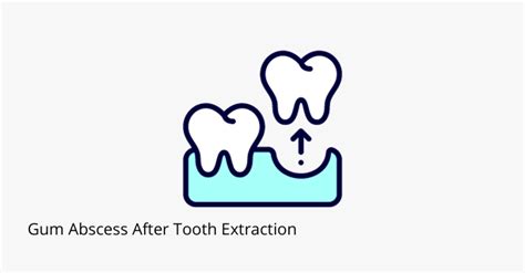 Image result for Abscess Tooth Extraction
