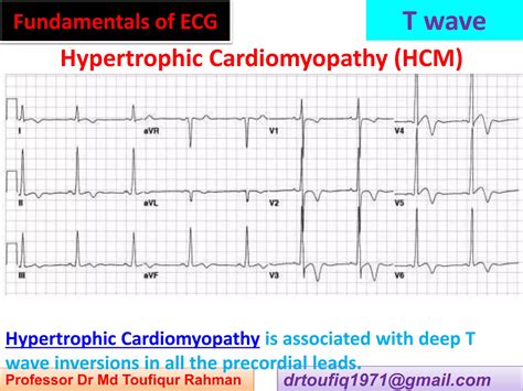 Approach to a patient with T wave abnormality in ECG | PPSX