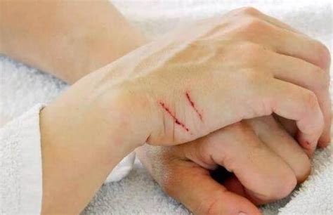徐冬冬晒出手部被猫抓伤的照片，两条血痕十分明显！……