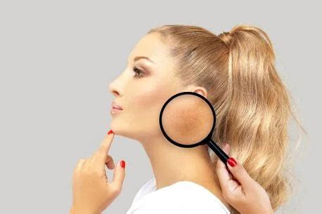 Hyperpigmentation Pictures | Photo Gallery Of Skin Pictures | The Pink ...