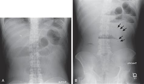 Abnormal Bowel Gas Patterns and Extraluminal Gas in Abdomen - Clinical Tree