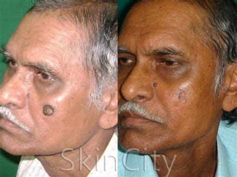 A Revolutionary Technology to Remove Birthmarks - Times of India