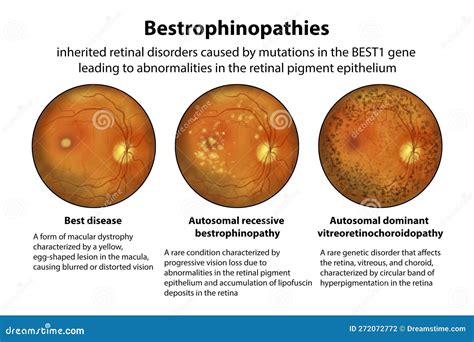 Bestrophinopathies, Inherited Retinal Disorders Caused by Mutations in ...