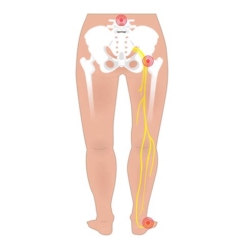 Why do I have tingling in my foot? — Physiotherapy London Ontario