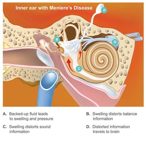 Difference Between Benign Paroxysmal Positional Vertigo (BPPV) and ...