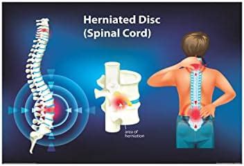 Anne Print Solutions® Herniated disc spinal cord Posters For Hospital ...