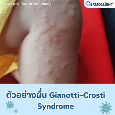 Gianotti-Crosti Syndrome โรคผื่นไวรัสที่พบบ่อยในเด็กเล็ก คืออะไร ...