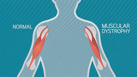 What Are the Signs and Symptoms of Duchenne Muscular Dystrophy?